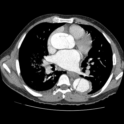 File:Aortic dissection - Stanford A -DeBakey I (Radiopaedia 28339-28587 B 50).jpg