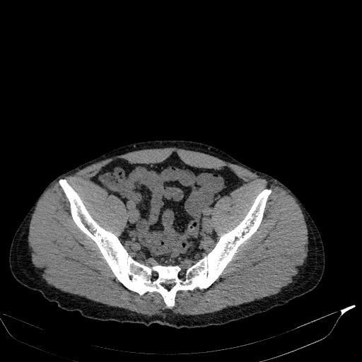 File:Aortic dissection - Stanford type A (Radiopaedia 83418-98500 Axial non-contrast 80).jpg