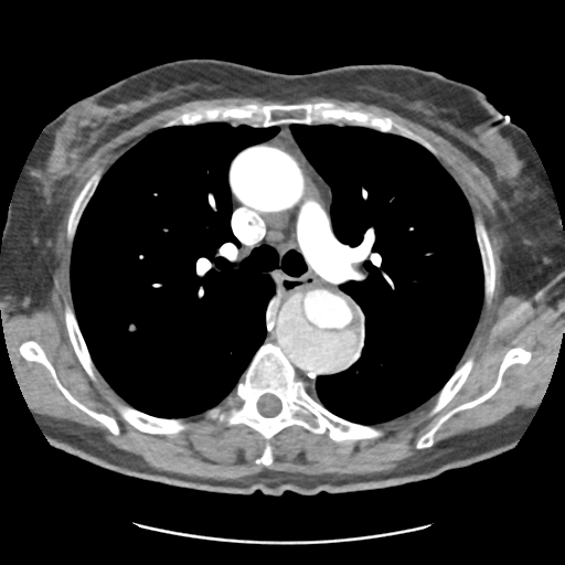 Aortic dissection - Stanford type B (Radiopaedia 50171-55512 A 19).png