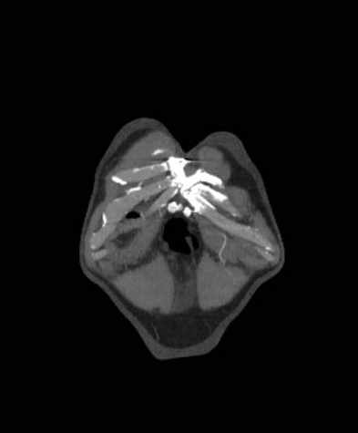 Aortic dissection - Stanford type B (Radiopaedia 73648-84437 B 3).jpg