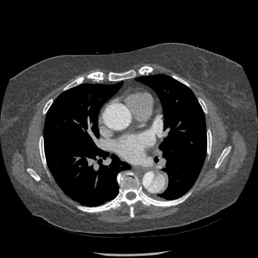 Aortic dissection - Stanford type B (Radiopaedia 88281-104910 A 44).jpg