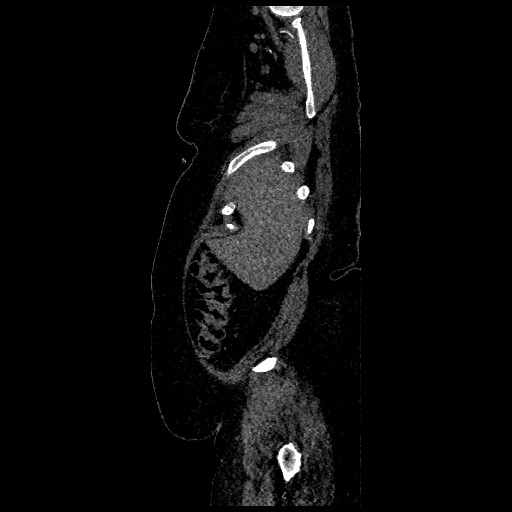 File:Aortic dissection - Stanford type B (Radiopaedia 88281-104910 C 6).jpg