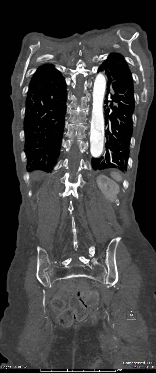 Aortic dissection with extension into aortic arch branches (Radiopaedia 64402-73204 A 64).jpg