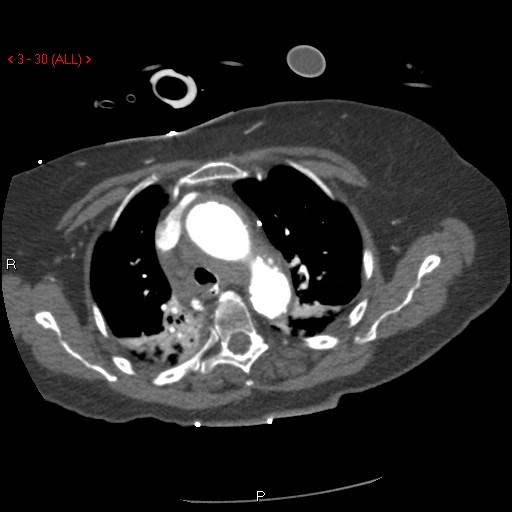 File:Aortic intramural hematoma (Radiopaedia 27746-28001 A 30).jpg