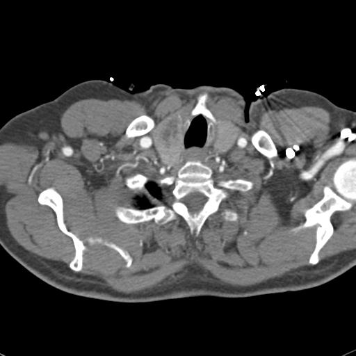 File:Aortic intramural hematoma (Radiopaedia 31139-31838 B 6).jpg