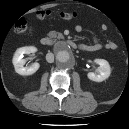 Aortic intramural hematoma (type B) (Radiopaedia 79323-92387 Axial C+ delayed 69).jpg