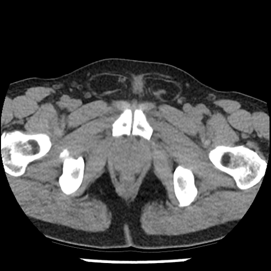 Aortic intramural hematoma (type B) (Radiopaedia 79323-92387 Axial non-contrast 117).jpg