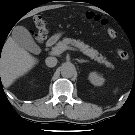 Aortic intramural hematoma (type B) (Radiopaedia 79323-92387 Axial non-contrast 60).jpg