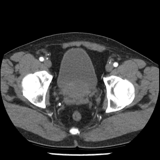 File:Aortic intramural hematoma (type B) (Radiopaedia 79323-92387 B 109).jpg
