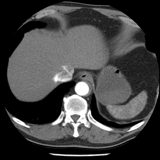 Aortic intramural hematoma (type B) (Radiopaedia 79323-92387 B 47).jpg