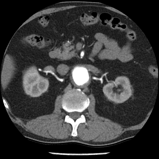 Aortic intramural hematoma (type B) (Radiopaedia 79323-92387 B 65).jpg