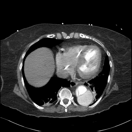 Aortic intramural hematoma with dissection and intramural blood pool (Radiopaedia 77373-89491 B 82).jpg