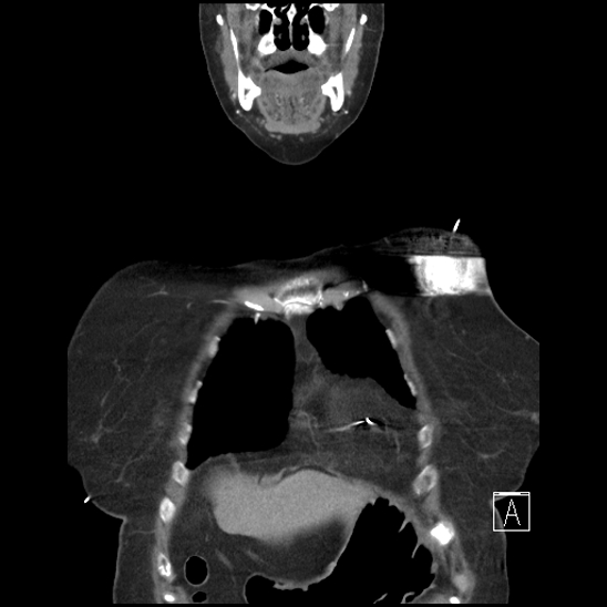 File:Aortic intramural hematoma with dissection and intramural blood pool (Radiopaedia 77373-89491 C 6).jpg