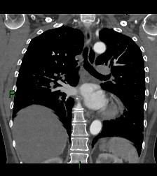 Aortic valve endocarditis (Radiopaedia 87209-103485 D 28).jpg