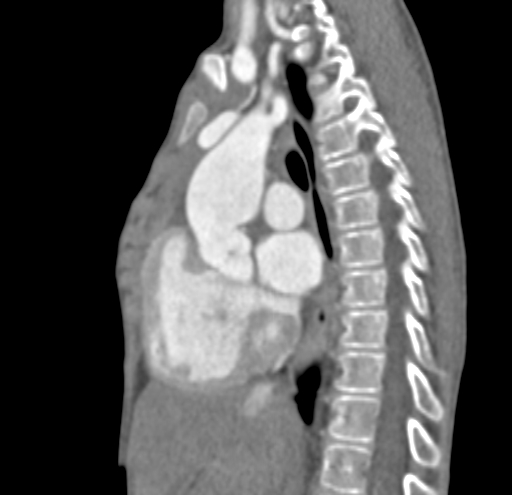 File:Aortopulmonary window, interrupted aortic arch and large PDA giving the descending aorta (Radiopaedia 35573-37074 C 17).jpg