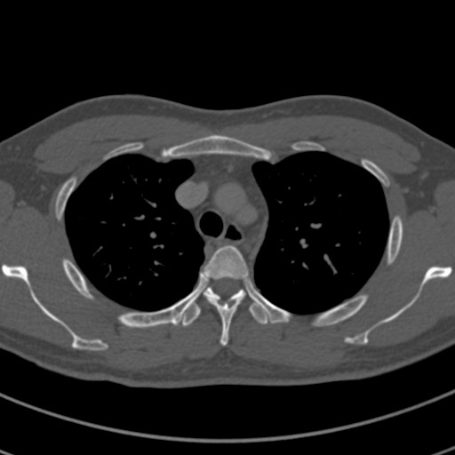 Apical lung mass mimic - neurogenic tumor (Radiopaedia 59918-67521 Axial bone window 22).jpg