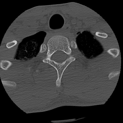 Apical pneumothorax on cervical spine CT (Radiopaedia 45343-49368 Axial bone window 87).jpg