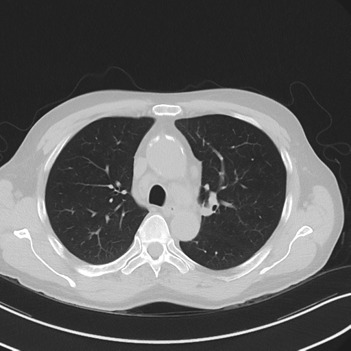 File:Apical pulmonary metastasis (Radiopaedia 46338-50754 Axial non-contrast 24).png