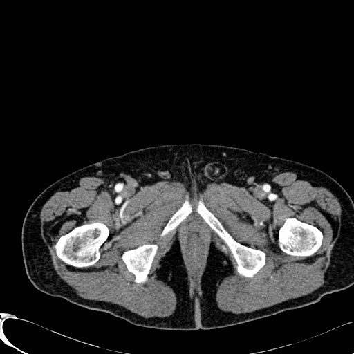 Appendiceal adenocarcinoma complicated by retroperitoneal abscess (Radiopaedia 58007-65039 B 151).jpg