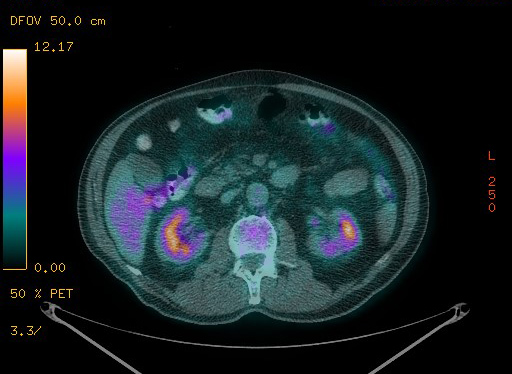 File:Appendiceal adenocarcinoma complicated by retroperitoneal abscess (Radiopaedia 58007-65041 Axial PET-CT 121).jpg