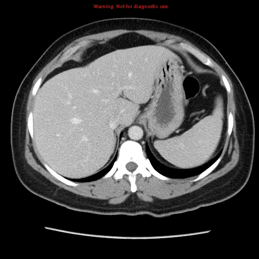 File:Appendiceal mucinous cystadenoma (Radiopaedia 8263-9111 Axial liver window 20).jpg