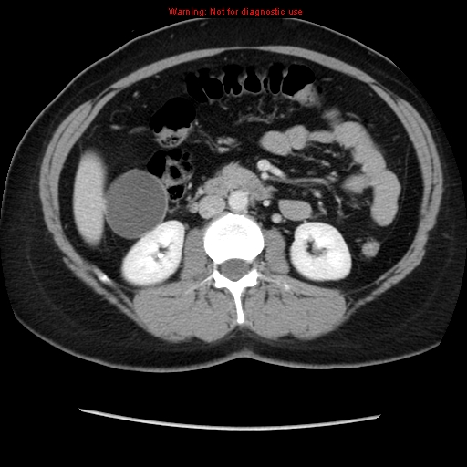 Appendiceal mucinous cystadenoma (Radiopaedia 8263-9111 Axial liver window 38).jpg