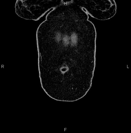 File:Appendiceal mucocele (Radiopaedia 82952-97298 C 6).jpg