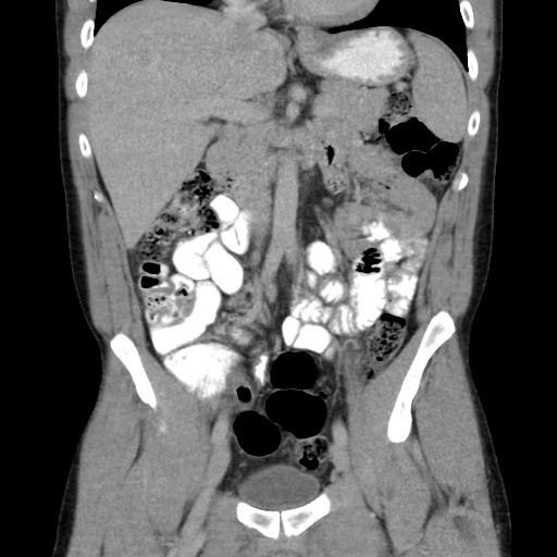 File:Appendicitis complicated by post-operative collection (Radiopaedia 35595-37113 B 25).jpg