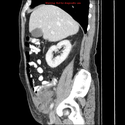 File:Appendicitis mass in inguinal hernia (Radiopaedia 26858-27029 C 15).jpg