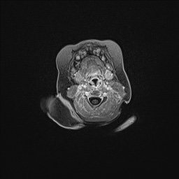 Aqueductal stenosis (Radiopaedia 73974-84802 Axial T1 C+ 14).jpg