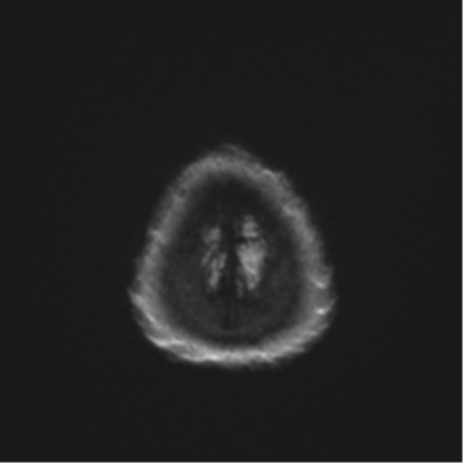 Arachnoid cyst - cerebellopontine angle (Radiopaedia 59689-67083 Axial DWI 72).png
