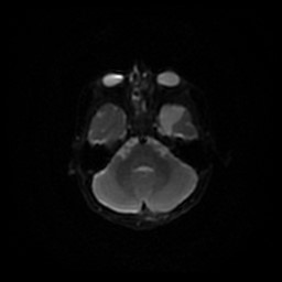 Arachnoid cyst - middle cranial fossa (Radiopaedia 86780-102938 Axial DWI 51).jpg