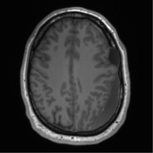 File:Arachnoid cyst with subdural hematoma (Radiopaedia 85892-101743 Axial T1 61).png