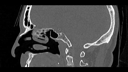 File:Arcuate foramen (Radiopaedia 89833-106944 Sagittal bone window 45).jpg