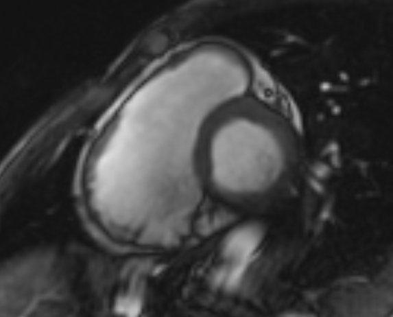 Arrhythmogenic right ventricular cardiomyopathy (Radiopaedia 69564-79464 short axis cine 205).jpg