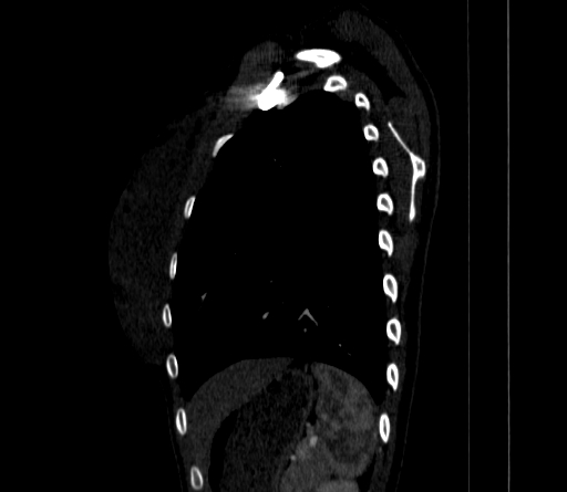 Arteria lusoria (Radiopaedia 88528-105192 C 73).jpg