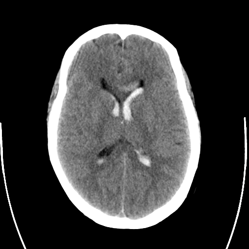 File:Arteriovenous malformation (cerebral) (Radiopaedia 40070-42579 Axial non-contrast 18).png