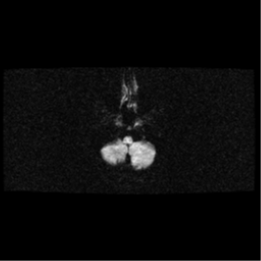 File:Arteriovenous malformation (cerebral) (Radiopaedia 40070-42580 Axial DWI 4).png