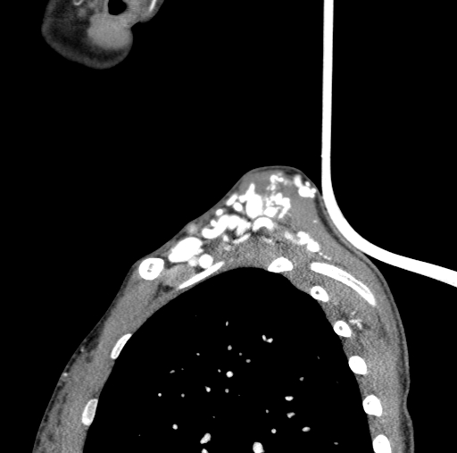 Arteriovenous malformation of the neck (Radiopaedia 53935-60062 C 5).jpg