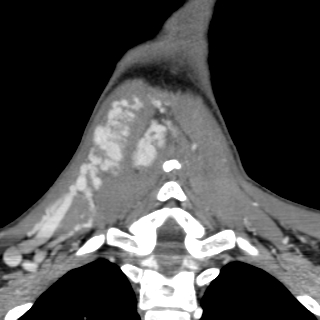 Arteriovenous malformation of the neck (Radiopaedia 53935-60062 D 41).jpg