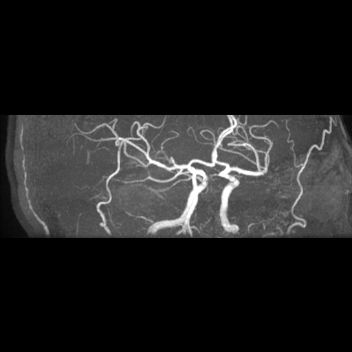Artery of Percheron infarction (Radiopaedia 27975-28230 3D TOF 15).jpg