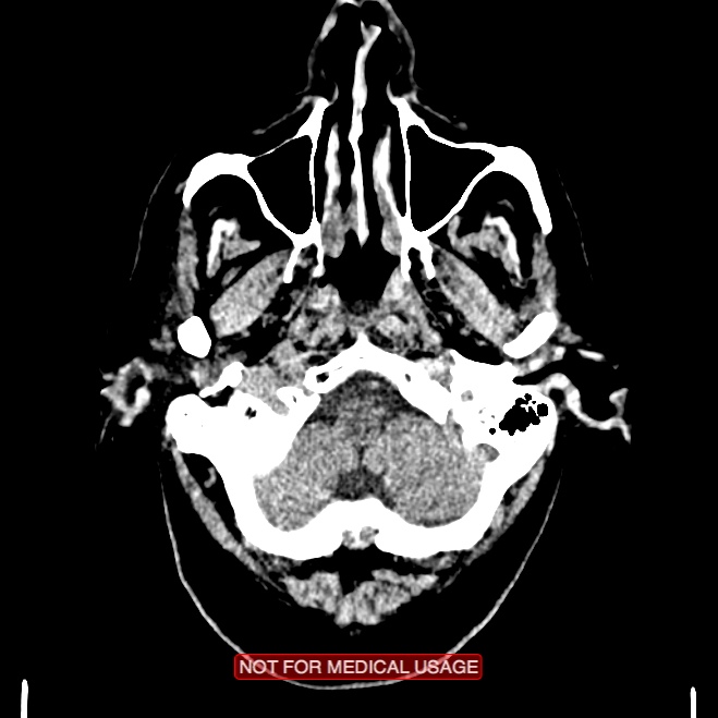 Artery of Percheron infarction (Radiopaedia 28679-28967 Axial non-contrast 13).jpg