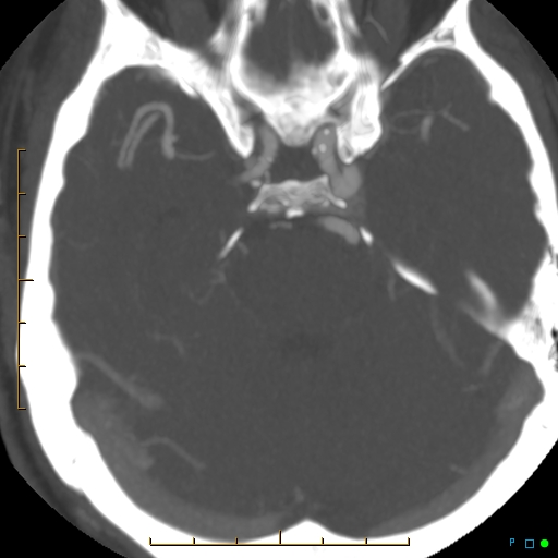 File:Artifactual basilar artery stenosis due to metallic stent (Radiopaedia 31206-31923 A 15).jpg