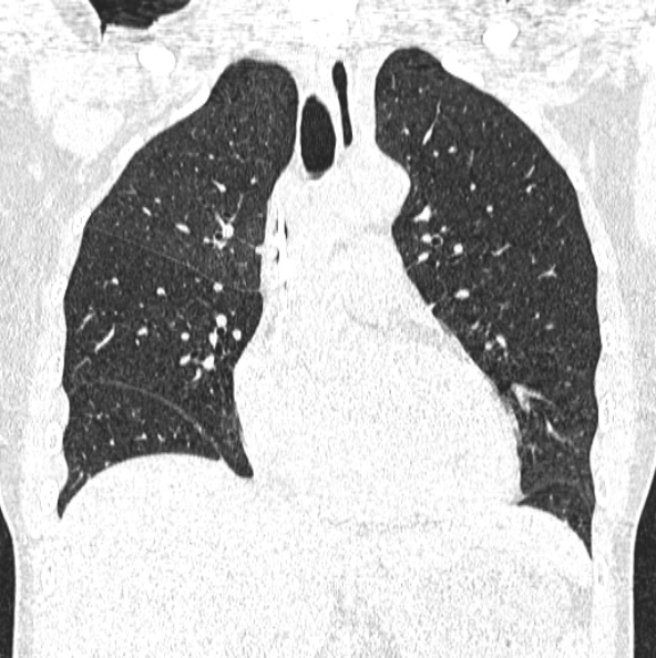 File:Aspergilloma (Radiopaedia 26223-26347 Coronal lung window 21).jpg