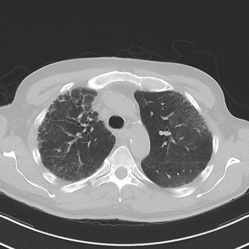 Aspergilloma on background pulmonary fibrosis (Radiopaedia 60942-68757 A 18).jpg
