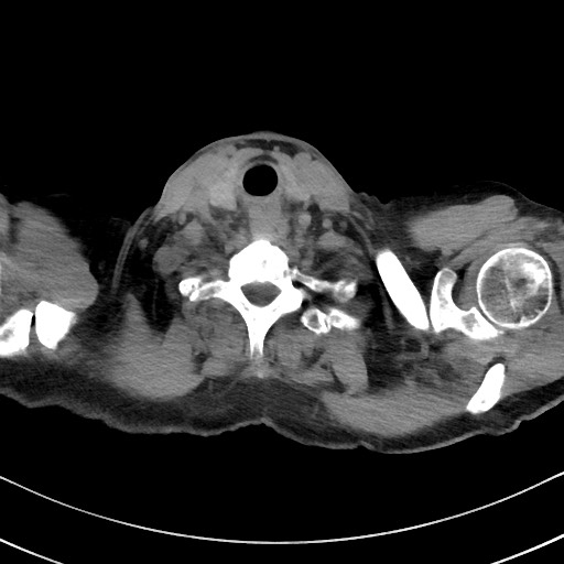 Aspergilloma on background pulmonary fibrosis (Radiopaedia 60942-68757 Axial non-contrast 2).jpg