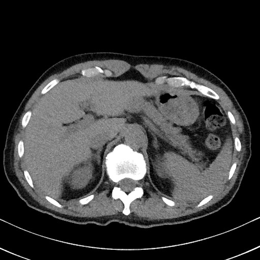 Aspergilloma on background pulmonary fibrosis (Radiopaedia 60942-68757 Axial non-contrast 57).jpg