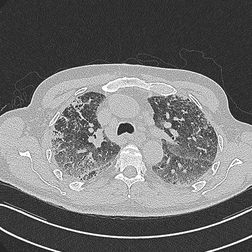 File:Aspergilloma on background pulmonary fibrosis (Radiopaedia 60942-68757 B 20).jpg