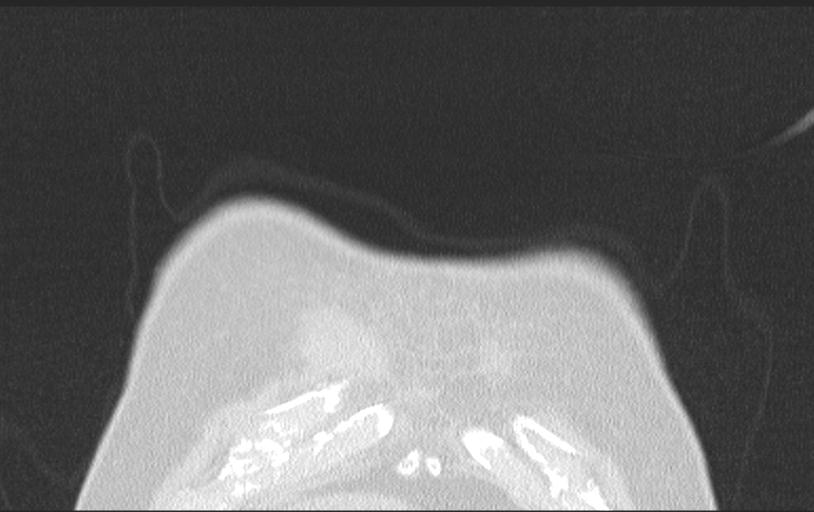 Aspirated tooth (Radiopaedia 28584-28844 Axial lung window 17).jpg