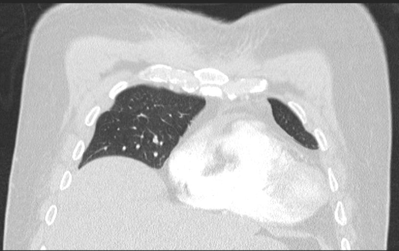 Aspirated tooth (Radiopaedia 28584-28844 Axial lung window 35).jpg